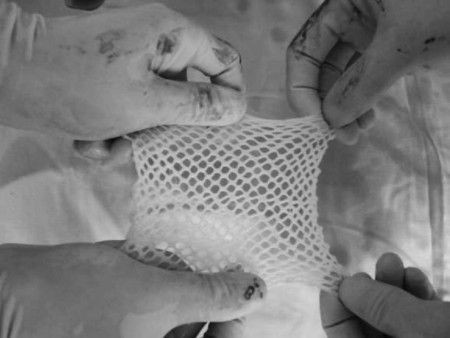 Fig. 4Meshed acellular ADM (J1 Jayya Acellular Dermis�).