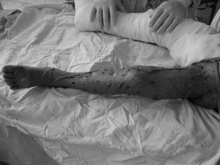 Fig. 7Left lower extremity further overlaid with autogenous microskin and large sheet of homograft.