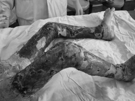 Fig. 10Wounds in both lower extremities almost completely resurfaced 19 days after operation