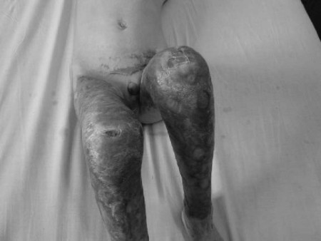 Fig. 11At 6-month follow-up, skin of right knee unstable and chronic residual ulcer 1 cm in diameter.