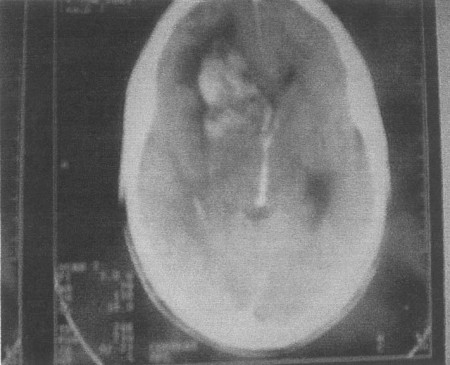 Fig. 1aH�morragie fronto-basillaire droite. Pas de l�sion osseuse.