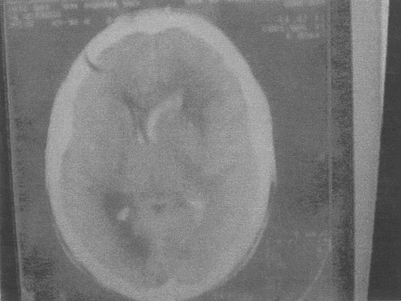 Fig. 1bH�morragie ventriculaire. Pas de l�sion osseuse.