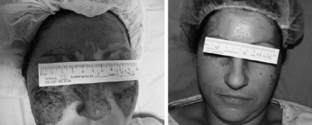 Fig. 2Female patient, 34 years old, thermal burn caused by flame, located on face, II degree. Initial aspect and after five days� treatment with the Immerci H3 impregnated compress.