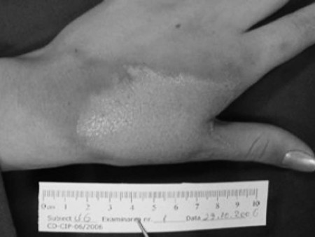 Fig. 3Female patient, 25 years old, thermal burn caused by hot liquid, left hand, dorsal face, I and II degree. Initial aspect and after 13 days� treatment with the Immerci H3 impregnated compress.