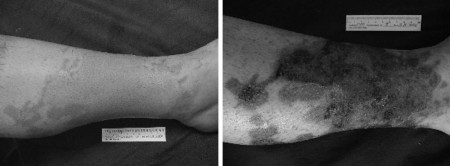 Fig. 4Superficial (IIa degree) burn of the calf. Initial aspect and after 11 days� treatment with the Immerci H3 impregnated compress.