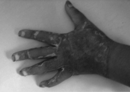 Fig. 1cCase 1, late post-op.
