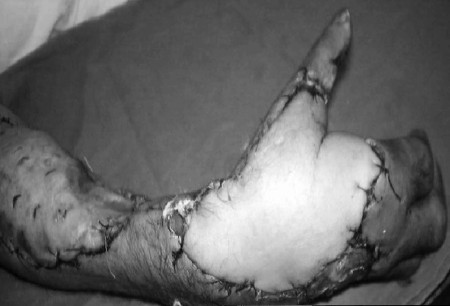 Fig. 2cCase 2, post-op.