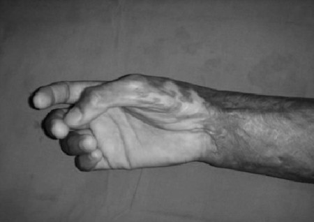 Fig. 6aCase 6, pre-op.