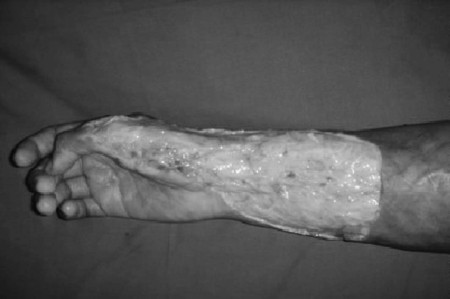 Fig. 6bCase 6, intra-op.
