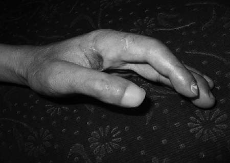 Fig. 4aCase 4, pre-operative.