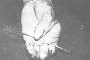 Fig. 3 B: Post-operative photograph after six weeks showing good thumb apposition.