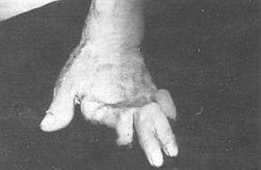 Fig. 4 A: A case of post-burn stiff hand