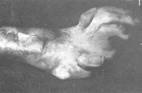 Fig. 5 A: A case of post-burn stiff hand showing marked M.P. joint deformity