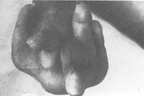 Fig. 6 A: A case of severe post-burn stiff hand 