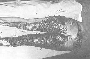 Fig. 3 Same case: . appearance of granulating surface after escharectomy.