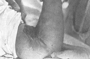 Fig. 1 Patient (No. 1, Table) with antecubital bum scar contracture of the left arm resulting in severe limitation of range of motion of the elbow
