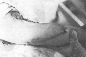 Fig. 2 Release of contracted soft tissue of the antecubital region and design of proximally based fasciocutancous forearm flap on the medial aspect of the forearm