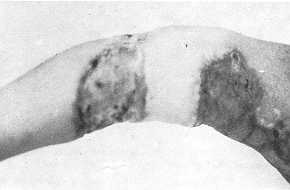 Fig. 4 Final appearance of the flap and donor defect with a split-thickness skin graft one month after operation