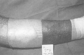 Fig. 1 The gel of DuoDERM E stays located around the wound, without leakage. 
