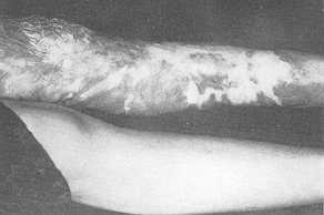 a) pre-operative
