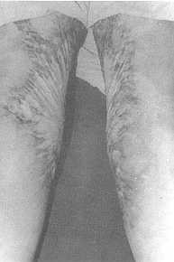 a) pre-operative