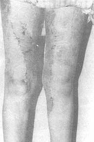 b) immediate post-operative after tangential skin excision and S.S.T.G.