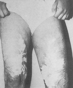 a) pre-operative