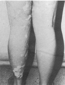 b) post-operative; the treated leukoderma was used again as a donor site in the left thigh