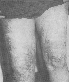 c) pre-operative