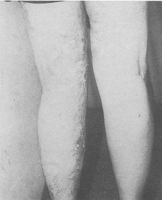 d) post-operative, using the skin taken from the treated leukoderma.