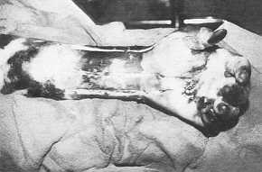 Fig. 1 Les mains sont brules au troisime degr en palmaire et en dorsal.