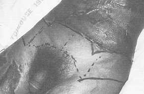 Fig. 3 Dessin des lambeaux inguinaux qui sont courts et d'un lambeau sus-pubien. 