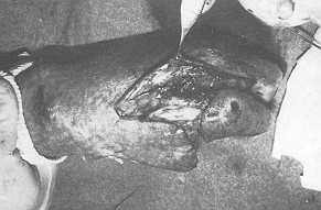 Fig. 7 Le temps dorsal permet d'isoler le deuxime mtacarpien et le systme extenseur.
