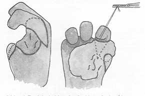 Schma 1 Trac des incisions dorsales (a) et palmaires (b).