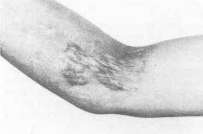 Fig. 5 Hypertrophic bum scar on the elbow area (a)