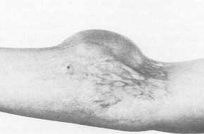 Fig. 5 (b) the position of a rectangular tissue expander under the adjacent healthy skin for a latter reconstruction of the scar. (The tissue expander is partially inflated.)