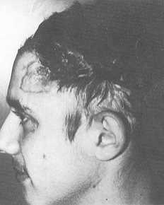 (A,B) Cicatrice alopécique de brûlure touchant la voute crânienne médiane, la ligne antérieure des cheveux et la zone latérale du front