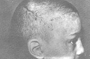 (B,C) Reconstitution de la ligne antérieure des cheveux par un lambeau de rotation et translation de la peau postérieure expansée