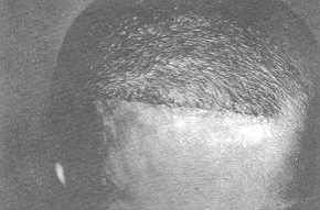 (B,C) Reconstitution de la ligne antérieure des cheveux par un lambeau de rotation et translation de la peau postérieure expansée