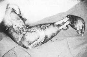 Fig. 1 A 25-year-old man with entrance injuries of a high-tension electrical bum. The current vaporized the soft tissues in the wrist and distal forearm. Shoulder disarticulation was performed.
