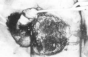 Fig. 2 Exit wounds of a high-tension electrical bum, involving the left thigh, penis and scrotum.