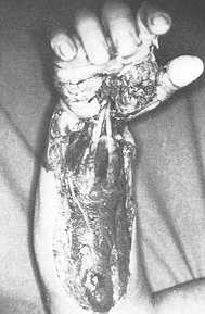 Fig. 3 High-tension electrical bum of the right upper extremity: Decompressive fasciotorny of forearm, with extension of surgical incision through the carpal tunnel space of the hand.