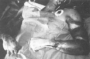 Fig. 4 An 18-year-old boy with high-tension electrical burns involving upper extremities.