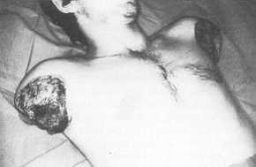 Fig. 5 Patient of figure 4. Bilateral amputation of upper extremities following high-tension electrical bums.