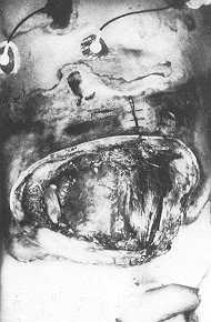 Fig. 6 A 45-year-old man with extensive destruction of the abdominal wall by high-tension electrical current. The patient died three days after injury.