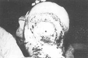Fig. 7 High-tension electrical bum of the scalp, skull and neck. The patient died nine days after injury.