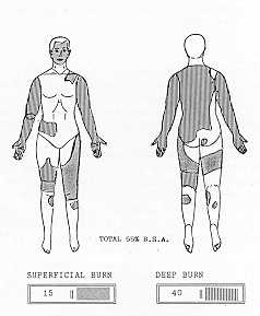 Fig. I Body surface area bum estimation chart of patient when he was admitted to the Bum Unit.
