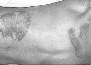 Fig. 4 Another patient with burns on the chest caused by a fire bull.