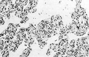 Fig. 6 Presence of plugged vessel by WBC aggregate in the patient's lung