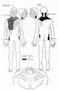 Fig. 2 Distribution of burns: case I